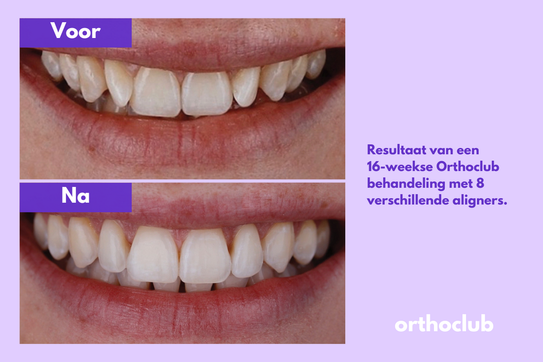 Onzichtbare beugel voor volwassenen: zijn aligners geschikt na je 18e?