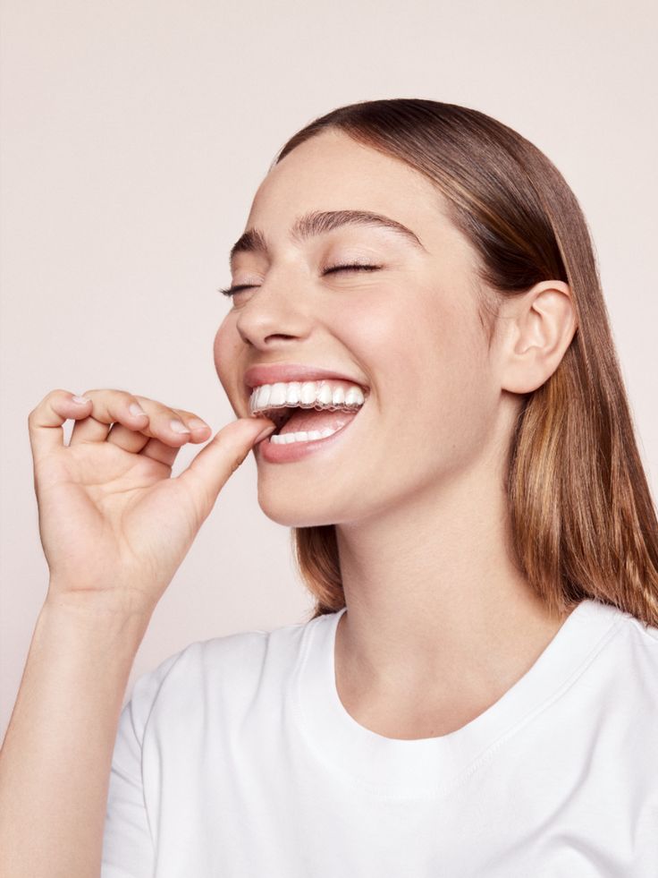 Orthoclub – Vrouw met aligner voor de boveste kaak