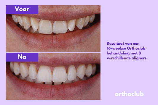 Onzichtbare beugel voor volwassenen: zijn aligners geschikt na je 18e?